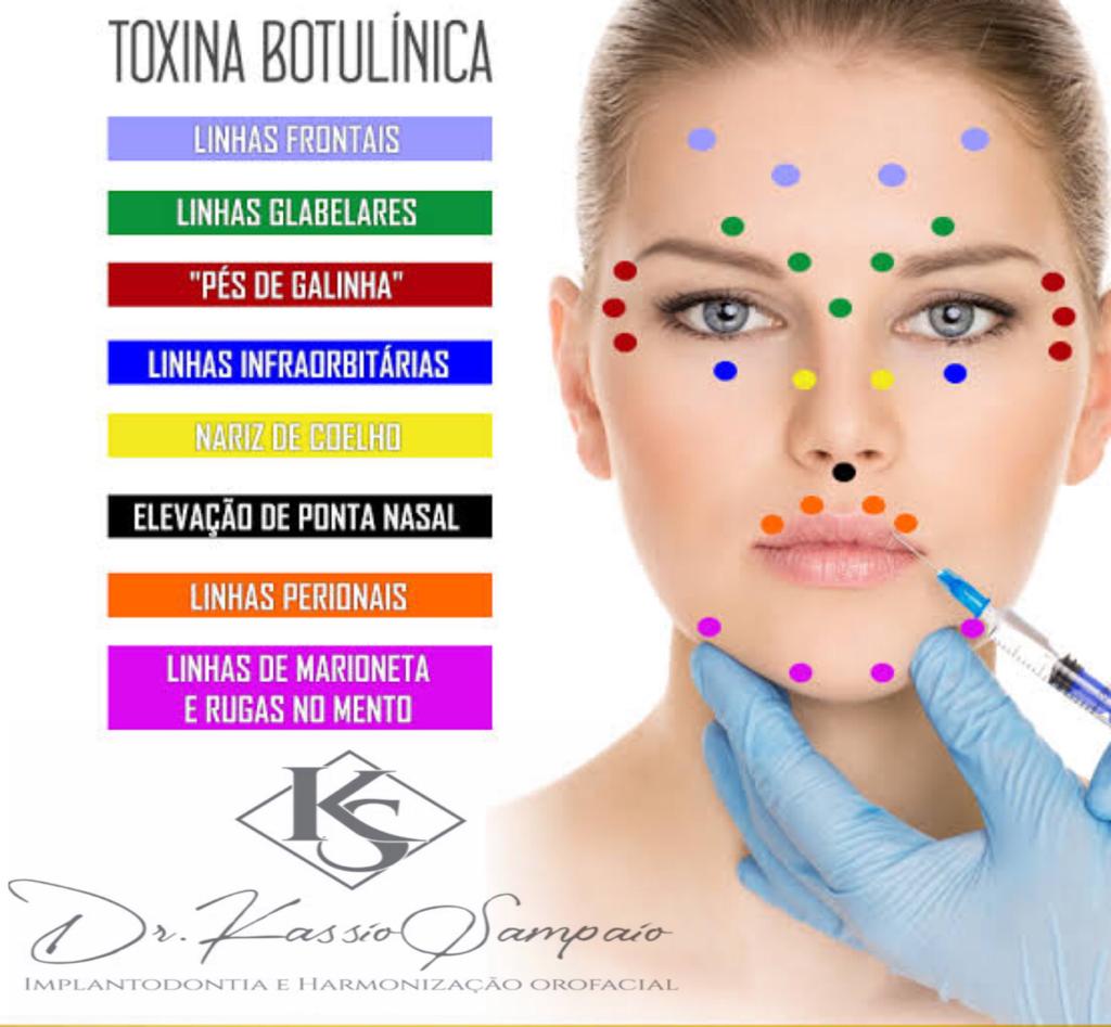 Tudo sobre toxina botul\u00ednica - BOTOX com o Cirurgi\u00e3o Dentista Dr ...